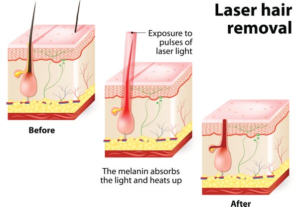 Laser-hårfjerning-i-huden