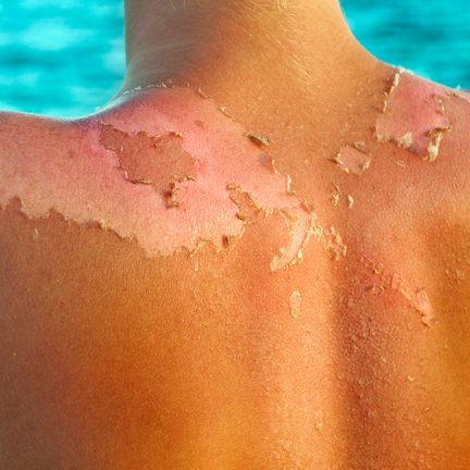 sunburn-peeling-skin-1555974888